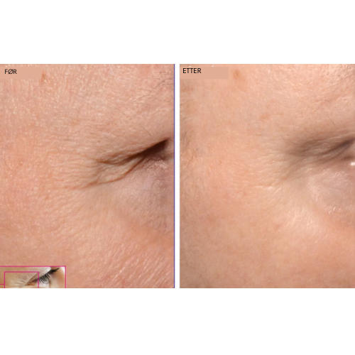 Romega® Skin Refine 3